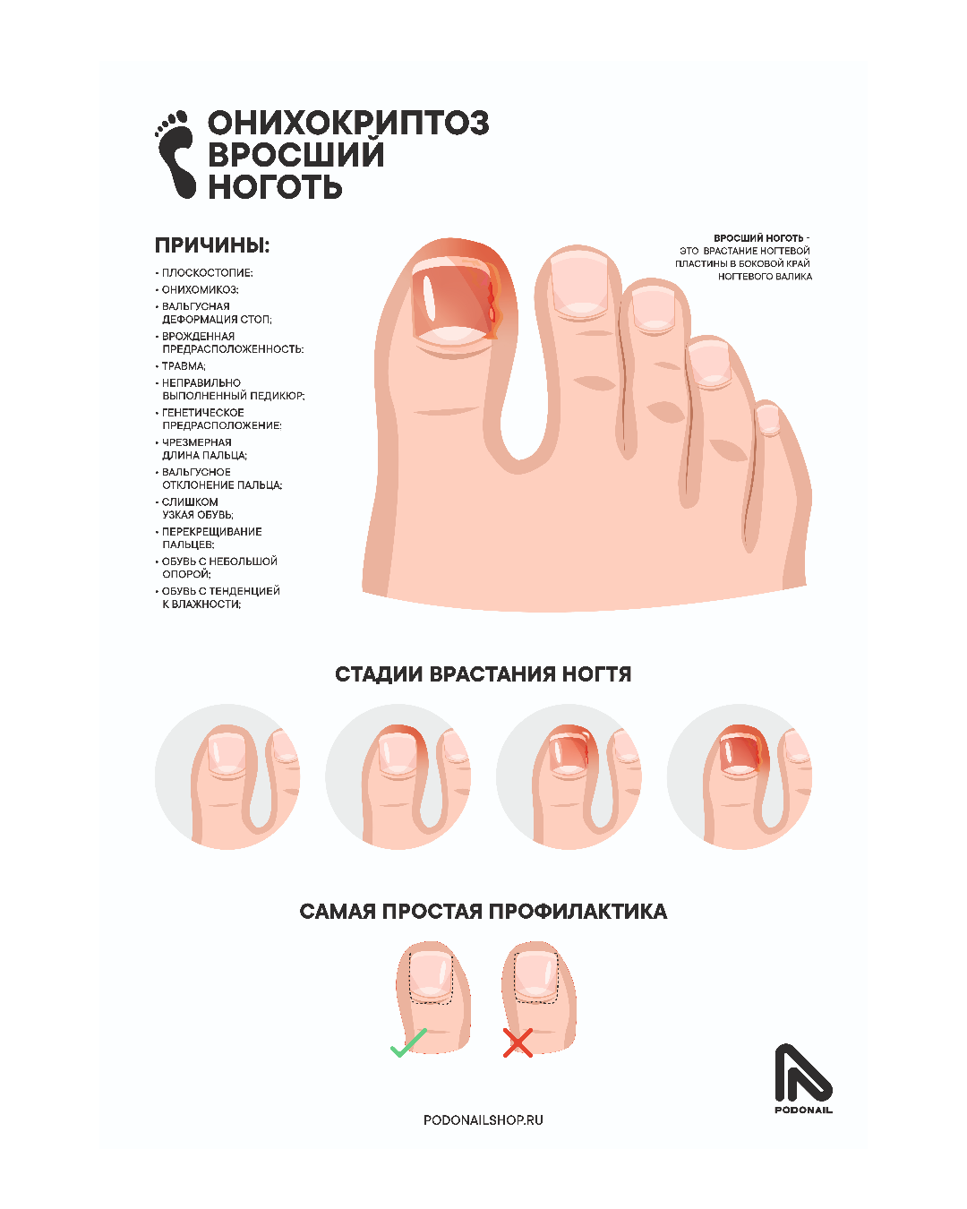 Плакат белый  А1  " Вросший ноготь"